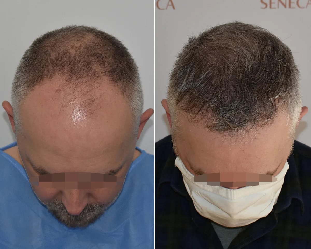Hair Transplant UK – Compare Costs, Techniques, and Results