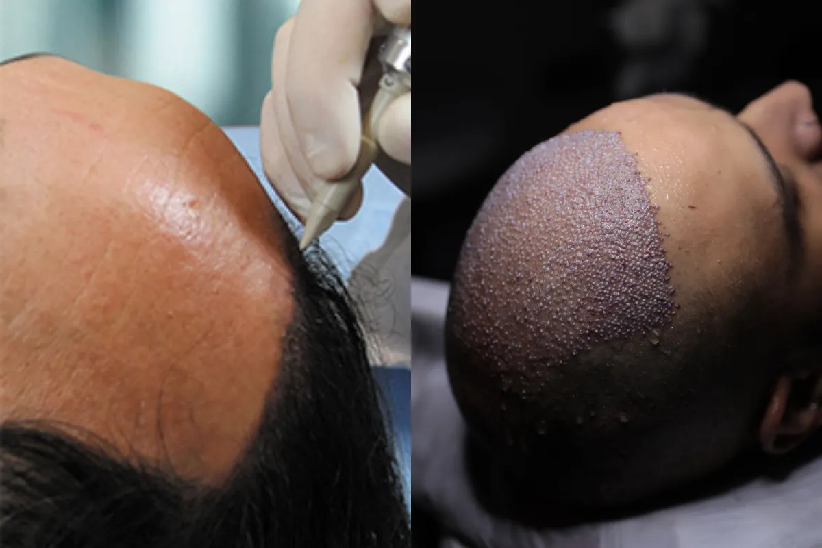 Hair Transplant Techniques – FUT vs FUE Explained
