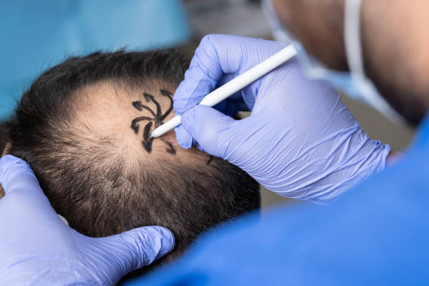Turkey Hair Transplant Cost vs UK and Europe